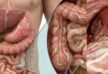 നിങ്ങളുടെ ശരീരത്തിൽ നിറയെ പാരസൈറ്റുകളും വിരകളും ഉണ്ടെന്നുള്ളതിന്റെ 10 ലക്ഷണങ്ങൾ ഒപ്പം അവയെ ഇല്ലാതാക്കുന്ന 7 ഭക്ഷണങ്ങളും.