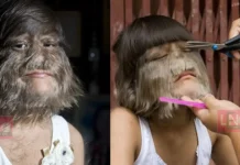 ‘ചെന്നായ മനുഷ്യൻ’ എന്ന് ലോകം വിളിച്ചു; ശരീരത്തിലെ രോമം പൂർണമായി വടിച്ചുമാറ്റി, പ്രണയത്തിന്റെ പുതിയ ലോകത്ത് സുപാത്ര; വൈറലായി മാറ്റം