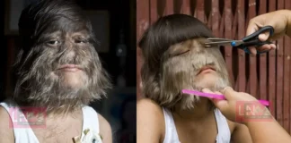 ‘ചെന്നായ മനുഷ്യൻ’ എന്ന് ലോകം വിളിച്ചു; ശരീരത്തിലെ രോമം പൂർണമായി വടിച്ചുമാറ്റി, പ്രണയത്തിന്റെ പുതിയ ലോകത്ത് സുപാത്ര; വൈറലായി മാറ്റം