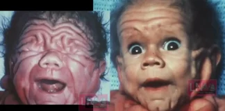 5 വയസ്സുകാരന്റെ ചർമ്മവുമായി ജനിച്ച കുഞ്ഞ്; അപൂർവ്വമായ അവസ്ഥ 30 വർഷങ്ങൾക്ക് ശേഷം ടോം ടെന്നന്റിന് സംഭവിച്ചത് കണ്ട് അമ്പരന്ന് ലോകം!