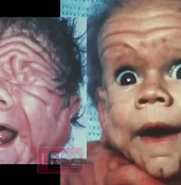 5 വയസ്സുകാരന്റെ ചർമ്മവുമായി ജനിച്ച കുഞ്ഞ്; അപൂർവ്വമായ അവസ്ഥ 30 വർഷങ്ങൾക്ക് ശേഷം ടോം ടെന്നന്റിന് സംഭവിച്ചത് കണ്ട് അമ്പരന്ന് ലോകം!