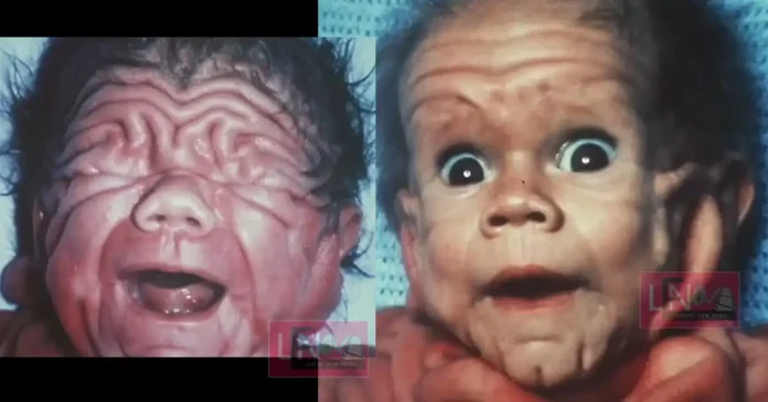 baby born with rare skin condition tom tennent