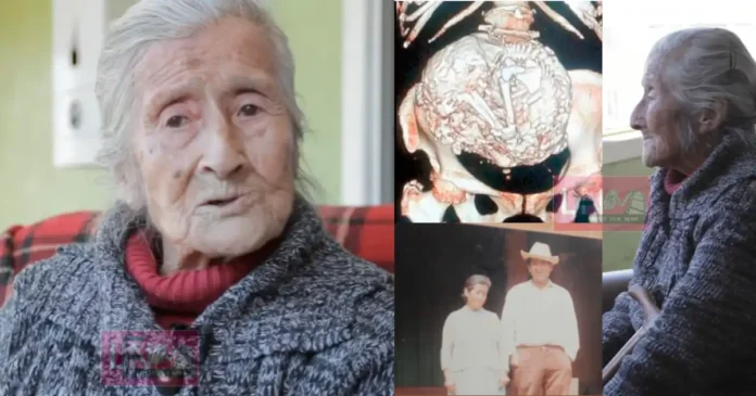 Estela Meléndez, 91 year old woman who carried a calcified fetus nearly 60 years in her utreus called lithopedion